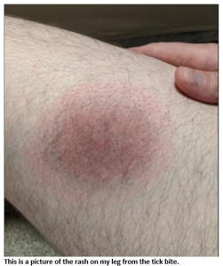 Tick bite rash